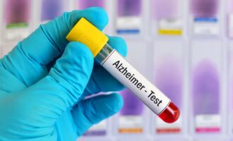 آزمایش خون آلزایمر