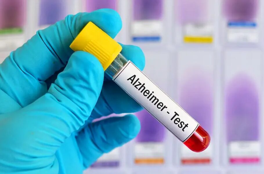 آزمایش خون آلزایمر