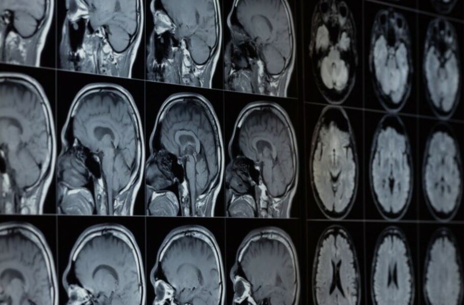 اسکن مغزی