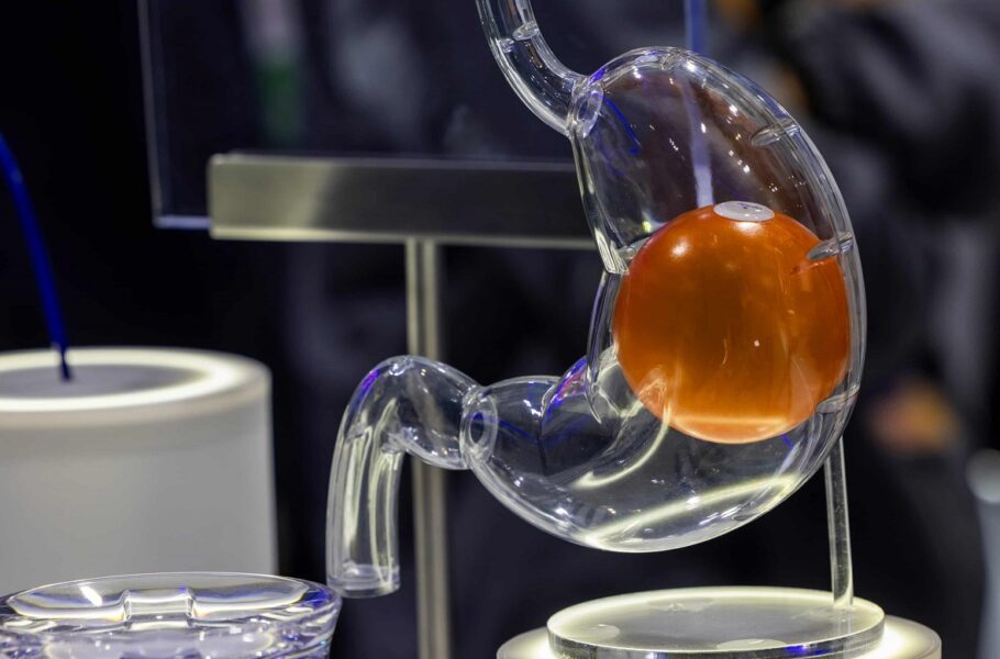 بالون معده جدید برای کاهش وزن